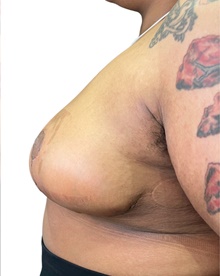 Breast Reduction After Photo by Mark Albert, MD; New York, NY - Case 48004