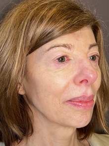 Eyelid Surgery Before Photo by Mark Albert, MD; New York, NY - Case 48008