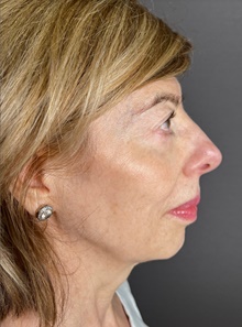 Eyelid Surgery After Photo by Mark Albert, MD; New York, NY - Case 48008