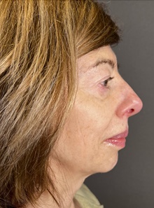 Eyelid Surgery Before Photo by Mark Albert, MD; New York, NY - Case 48008