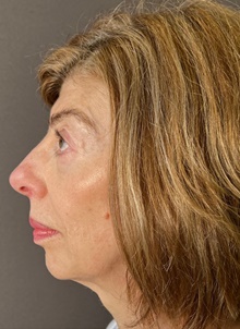 Eyelid Surgery After Photo by Mark Albert, MD; New York, NY - Case 48008