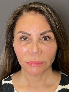 Facelift After Photo by Mark Albert, MD; New York, NY - Case 48009