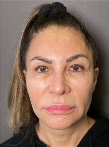 Facelift Before Photo by Mark Albert, MD; New York, NY - Case 48009