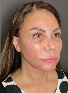 Facelift After Photo by Mark Albert, MD; New York, NY - Case 48009