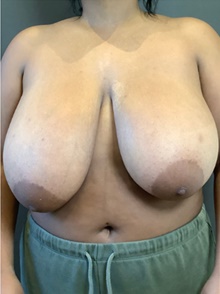 Breast Reduction Before Photo by Mark Albert, MD; New York, NY - Case 48044