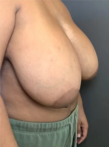 Breast Reduction Before Photo by Mark Albert, MD; New York, NY - Case 48044