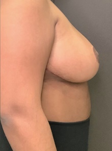 Breast Reduction After Photo by Mark Albert, MD; New York, NY - Case 48044