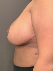 Breast Reduction After Photo by Mark Albert, MD; New York, NY - Case 48044
