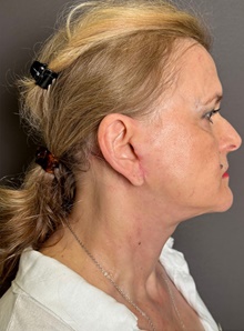 Neck Lift After Photo by Mark Albert, MD; New York, NY - Case 48121