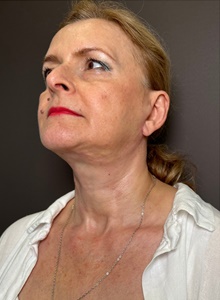 Neck Lift After Photo by Mark Albert, MD; New York, NY - Case 48121