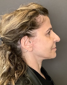 Neck Lift After Photo by Mark Albert, MD; New York, NY - Case 48505