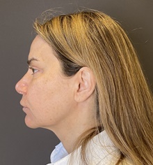 Facelift Before Photo by Mark Albert, MD; New York, NY - Case 48509