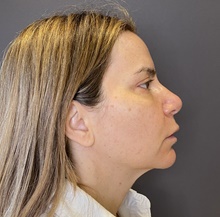 Facelift Before Photo by Mark Albert, MD; New York, NY - Case 48509