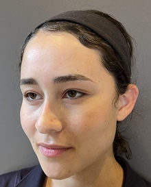 Eyelid Surgery After Photo by Mark Albert, MD; New York, NY - Case 48511