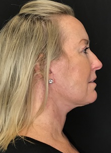 Neck Lift After Photo by Mark Albert, MD; New York, NY - Case 48513