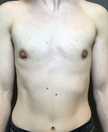 Transmasculine Top Surgery After Photo by Mark Albert, MD; New York, NY - Case 48515