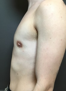 Transmasculine Top Surgery After Photo by Mark Albert, MD; New York, NY - Case 48515