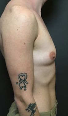 Transmasculine Top Surgery Before Photo by Mark Albert, MD; New York, NY - Case 48515