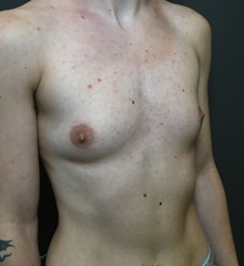 Transmasculine Top Surgery Before Photo by Mark Albert, MD; New York, NY - Case 48515