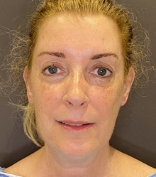 Facelift Before Photo by Mark Albert, MD; New York, NY - Case 48517