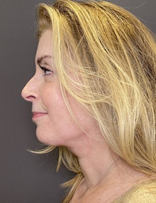 Facelift After Photo by Mark Albert, MD; New York, NY - Case 48517