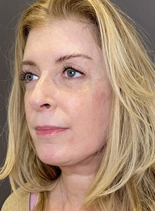 Facelift After Photo by Mark Albert, MD; New York, NY - Case 48517