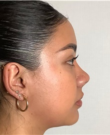 Rhinoplasty After Photo by Mark Albert, MD; New York, NY - Case 48907