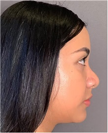 Rhinoplasty Before Photo by Mark Albert, MD; New York, NY - Case 48907