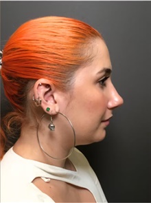 Rhinoplasty After Photo by Mark Albert, MD; New York, NY - Case 49003