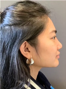 Rhinoplasty After Photo by Mark Albert, MD; New York, NY - Case 49012