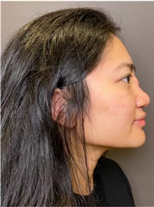 Rhinoplasty Before Photo by Mark Albert, MD; New York, NY - Case 49012