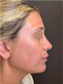 Rhinoplasty After Photo by Mark Albert, MD; New York, NY - Case 49013