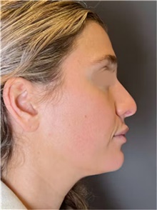 Rhinoplasty Before Photo by Mark Albert, MD; New York, NY - Case 49013