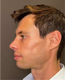 Rhinoplasty After Photo by Mark Albert, MD; New York, NY - Case 49034