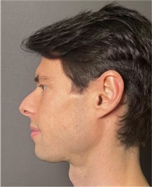 Rhinoplasty Before Photo by Mark Albert, MD; New York, NY - Case 49034