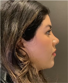 Rhinoplasty After Photo by Mark Albert, MD; New York, NY - Case 49035