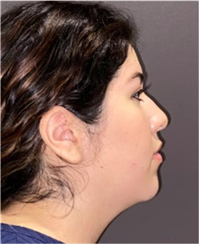 Rhinoplasty Before Photo by Mark Albert, MD; New York, NY - Case 49035