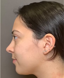 Rhinoplasty After Photo by Mark Albert, MD; New York, NY - Case 49044