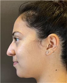 Rhinoplasty Before Photo by Mark Albert, MD; New York, NY - Case 49044