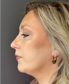 Rhinoplasty After Photo by Mark Albert, MD; New York, NY - Case 49045