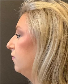 Rhinoplasty Before Photo by Mark Albert, MD; New York, NY - Case 49045