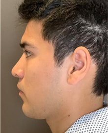 Rhinoplasty After Photo by Mark Albert, MD; New York, NY - Case 49047