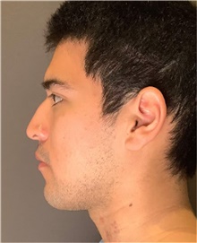 Rhinoplasty Before Photo by Mark Albert, MD; New York, NY - Case 49047