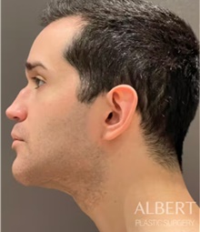 Chin Augmentation After Photo by Mark Albert, MD; New York, NY - Case 49049