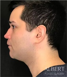 Chin Augmentation Before Photo by Mark Albert, MD; New York, NY - Case 49049