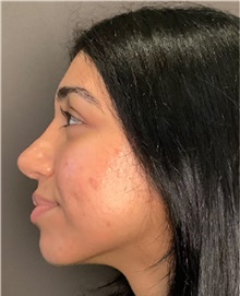 Rhinoplasty After Photo by Mark Albert, MD; New York, NY - Case 49050