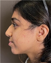 Rhinoplasty Before Photo by Mark Albert, MD; New York, NY - Case 49050