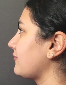 Rhinoplasty After Photo by Mark Albert, MD; New York, NY - Case 49133