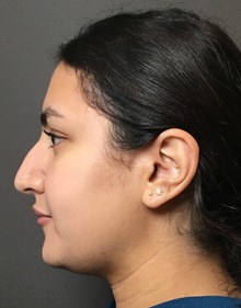 Rhinoplasty Before Photo by Mark Albert, MD; New York, NY - Case 49133