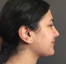 Rhinoplasty After Photo by Mark Albert, MD; New York, NY - Case 49133